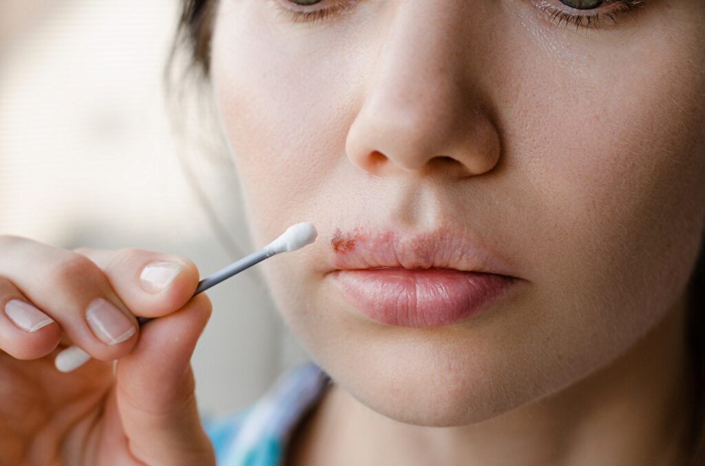 Mulher tratando uma herpes labial com um cotonete